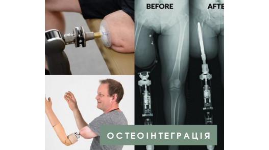 Остеоінтеграція: to be or not to be?